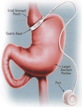 Adjustable Band Bariatric Surgery, New York Illustration Image - William A. Graber, MD, PC