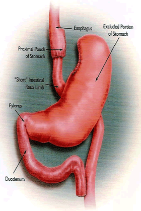Gastric Bypass Surgery, Syracuse NY Procedure Illustration Image - William A. Graber, MD, PC