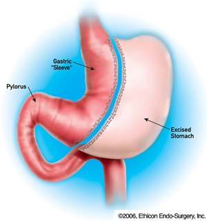 Gastric Sleeve, New York Procedure Illustration Image - William A. Graber, MD, PC